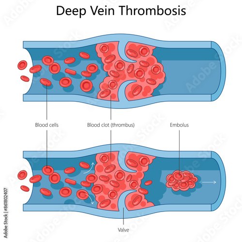 formation of a blood clot in a vein, representing Deep Vein Thrombosis DVT and its progression structure diagram hand drawn schematic vector illustration. Medical science educational illustration