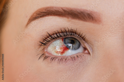 Blue eye on the right side of a woman, without identifying the person, with ocular hemorrhage, highlighting the red bleeding in this eye.