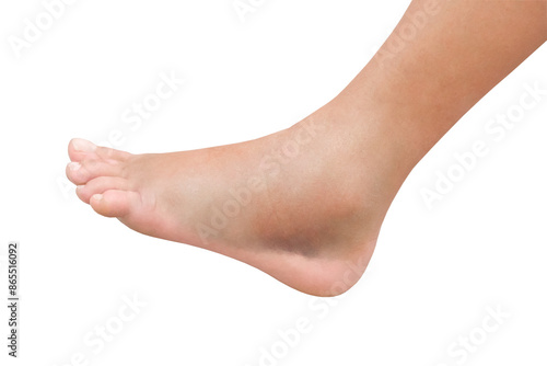 female injured leg with swelling and hematomas, isolated on white background