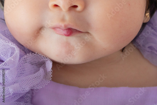 Hemangioma benign tumor on Little newborn tiny human baby on the lip