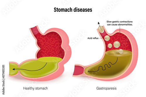 Stomach diseases. Comparison of healthy stomach and gastroparesis. Gastrointestinal Disorders. Vector for use in scientific and medical education.