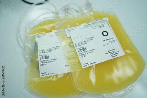 Single Donor Platelets (SDPs) are platelets collected from one donor, providing a concentrated and safer platelet transfusion compared to multiple donor sources.