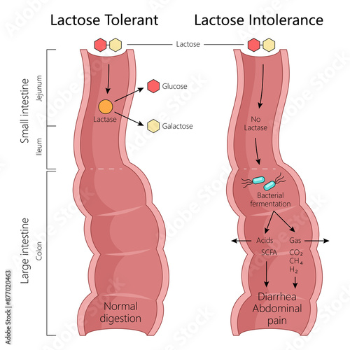 lactose tolerance and intolerance, normal digestion with lactase and symptoms from bacterial fermentation diagram hand drawn schematic raster illustration. Medical science educational illustration