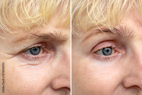 Close-up of an elderly woman's eye before and after blepharoplasty. Rejuvenation procedure, correction of the upper and lower eyelids. Removing wrinkles and puffiness under the eyes. Mesotherapy