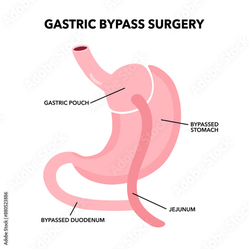 Gastric bypass gastroplasty operation. Obesity problem, weight loss procedure.