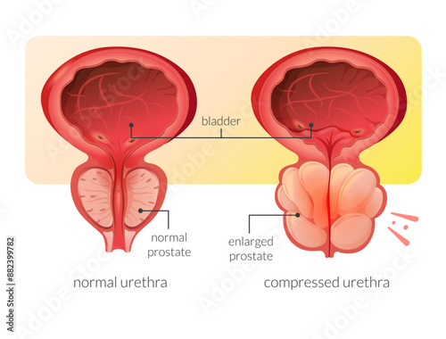 Normal Prostate and Enlarged Prostate Gland under Bladder - Stock Illustration