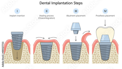 steps of dental implantation, implant insertion, healing process, abutment placement, prosthesis placement diagram hand drawn schematic raster illustration. Medical science educational illustration