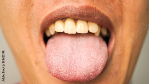 Close-up photo of a man sticking his tongue out, showing the detailed papillae on the tongue's surface. Concept for mouth and dental health