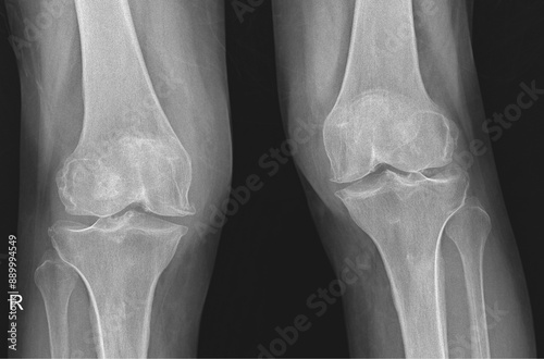 X-ray of Both Human Knee 