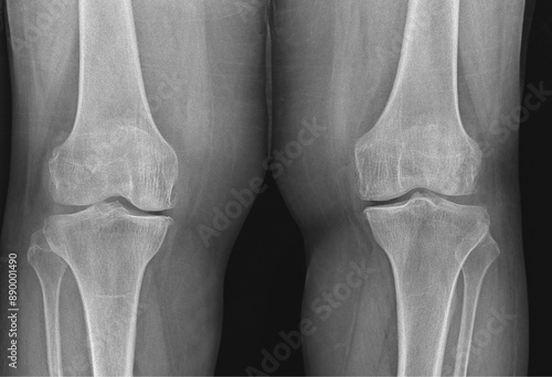 Knee X-ray of Femur Tibia Fibula and Patella