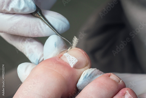 Medical pedicure, podiatrist doing tamponade to a deformed toenail