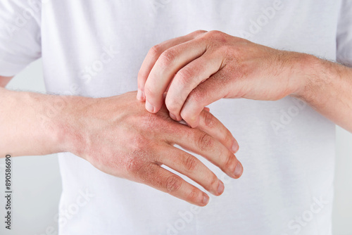 Man scratches or shows hands with dry, cracked skin on white backgrounds. Problem with many people - eczema on hand, allergies or dry skin. Health care concept. Close up.