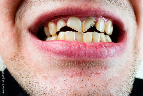 Broken, cracked front teeth in a man's mouth. Dental trauma, restoration, treatment close-up.