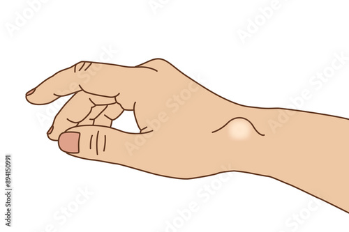 Ganglion cyst of the right wrist, illustration on white background