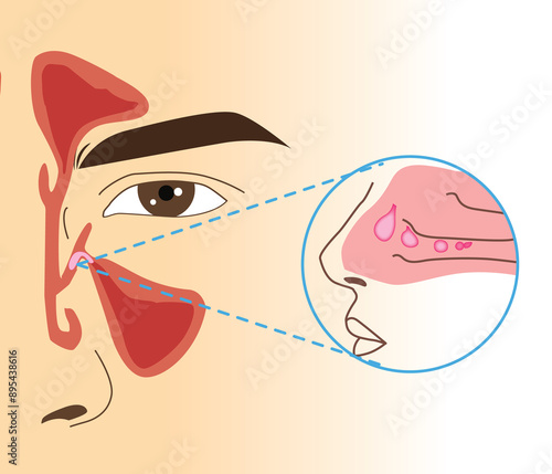 ์Nasal polyp section in human, illustration close up and zoom