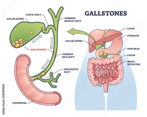 Gallstones as stones of cholesterol in gallbladder outline diagram, transparent background. Labeled educational scheme with bile ducts blockage and painful problem illustration.