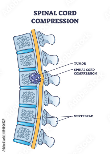 Spinal cord compression with tumor and vertebrae condition outline diagram, transparent background. Painful back cause with medical problem explanation illustration.