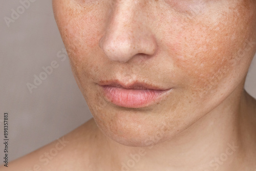 Close up caucasian woman's face with freckles or age spots. Age spots on the face