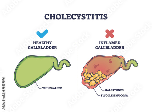 Cholecystitis as inflamed gallbladder compared with healthy outline diagram, transparent background. Labeled educational scheme with swollen mucosa and gallstones in digestive tract illustration.