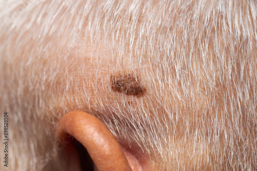 Brown mole on the head of an elderly person, nevus and melanoma, close-up, dermatology