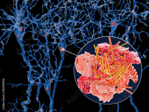 Neurons with Lewy bodies