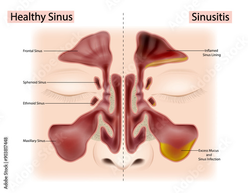 Healthy Sinus and Sinusitis or Rhinosinusitis. Excess Mucus and Sinus Infection