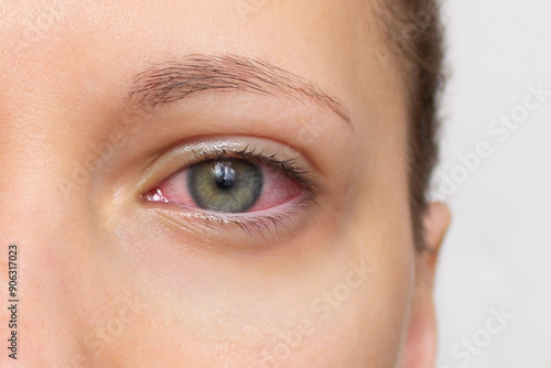 Close up of woman face with red eye. Swollen eyelids, irritation and itching of eyes caused by conjunctivitis, allergy, inflammation, infection. Dry eye syndrome