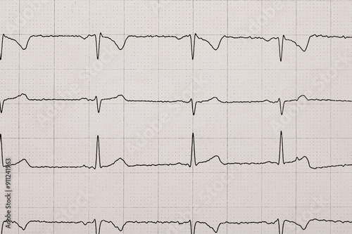 Badanie ekg wyniki na papierze