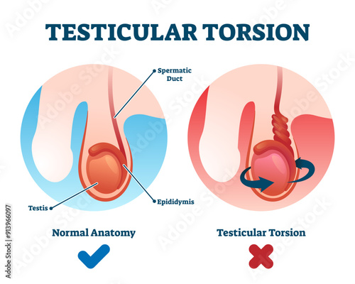 Testicular torsion illustration, transparent background. Labeled spermatic cord twist diagnosis scheme. Compared educational normal and abnormal anatomy.