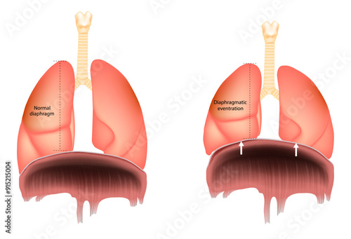 Normal diaphragm or Diaphragmatic eventration. Abnormal elevation of a portion or entire hemidiaphragm. Paralysis of the diaphragm