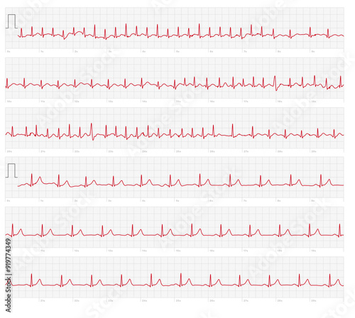 EKG ECG electrocardiogram showing AFIB and Supraventricular tachycardia followed by baseline reading