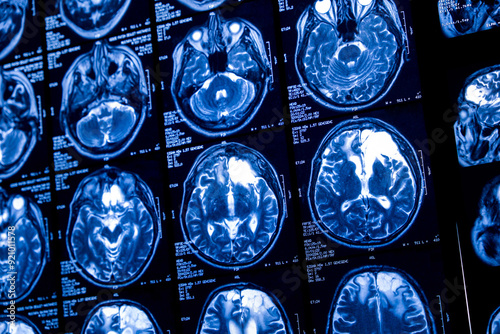 Close-up of CT scan with brain. Medicine, science and education MRI brain background. Magnetic resonance imaging. Tomography shot