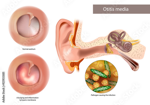 Otitis Media or Chronic Suppurative. Pathogen causing the infection. Normal eardrum and bulging and inflammation tympanic membrane. 