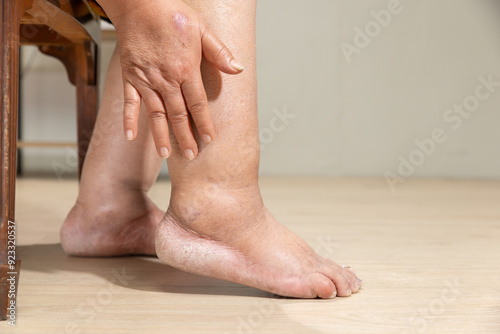 Woman's leg is edema (swelling) after cancer treatment.