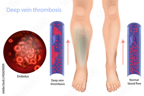 Deep vein thrombosis and Normal blood flow. Abnormally of blood floow. Medical Diagram 