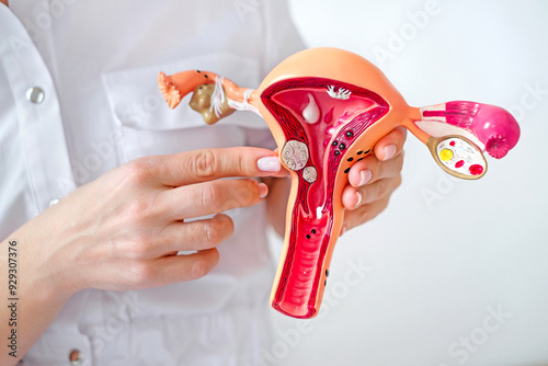 The gynecologist points his finger at fibroid tumors on a model of a female uterus with pathologies