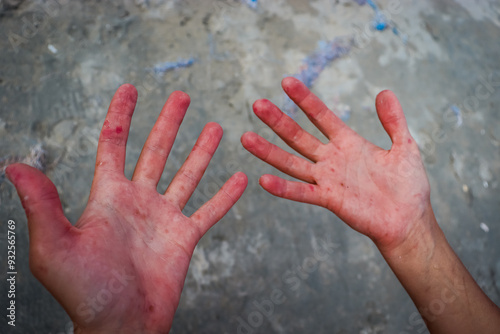 Coxsackie virus. Pimples on the palms. An unpleasant disease.