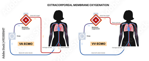 Extracorporeal membrane oxygenation