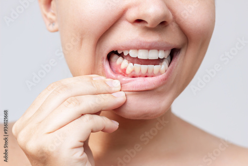 A red lump on the gum near the tooth. Gingivitis, gum inflammation. Cropped shot of a young woman showing red inflamed gums isolated on a white background. Close up. Dentistry, dental care