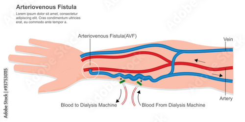 Arteriovenous fistula is surgical procedure in which small incision.