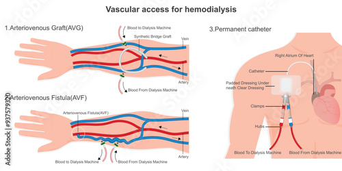 Vascular access for hemodialysis.