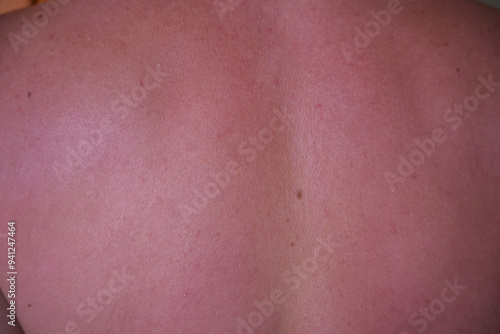 sunburn on the skin of a man. swollen skin from blisters on the boy's shoulder. red skin he has an overabundance of sun. sunburn at a dangerous hour