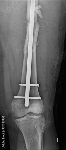 Femur X-ray Revealing Intramedullary Nail with Distal Locking Screw