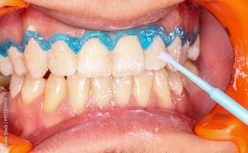 A blue gel applied in arcs on the neck of the maxillary teeth to protect the gingival gum from the agressif dental bleaching process applied with a brush. An orange cheek retractor keeps mouth open