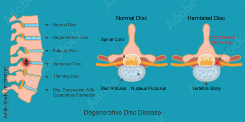 Degenerative Disc Disease is a fragment of the disc nucleus.