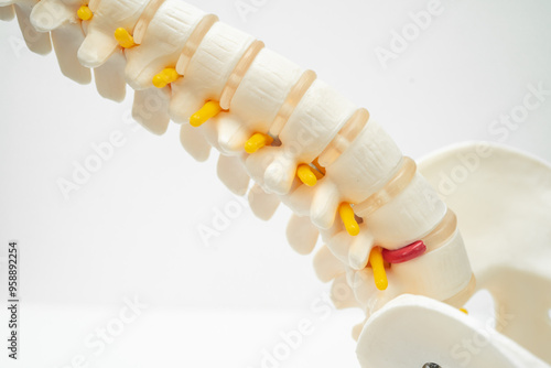 Lumbar spine displaced herniated disc fragment, spinal nerve and bone. Model for treatment medical in the orthopedic department.