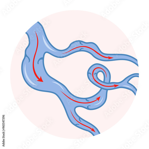 Varicose veins. Blue blood vessel visible through the skin. Vascular disease diagnostic and treatment. Venous insufficiency medical