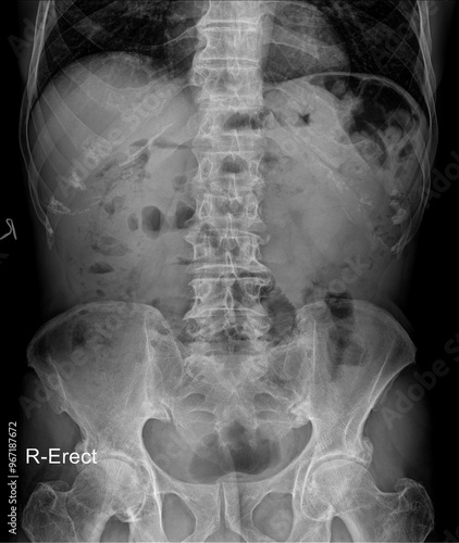 Erect Abdomen Digital Radiograph: Imaging for Abdominal pathology 