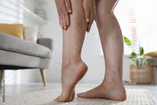 Woman suffering from varicose veins indoors, closeup