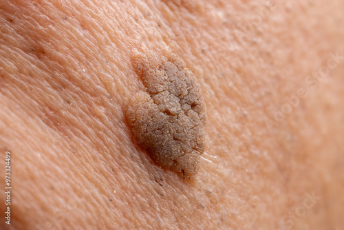 Close-Up of Brown Seborrheic Keratosis (Seborrhoeic wart, Basal cell papilloma, Senile wart) Skin Growth on Cheek